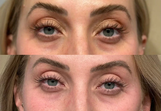 Under Eye Refresh at FitLab