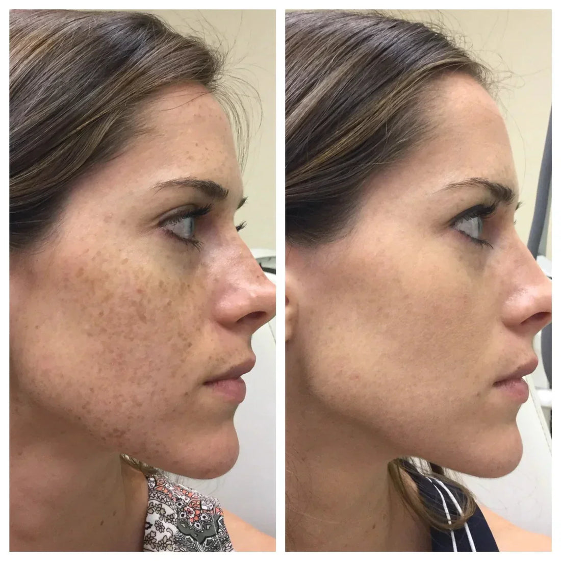 Laser treatments
