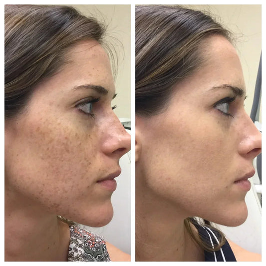 Laser treatments