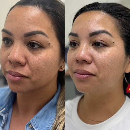 What You Need to Know About IPL Facials