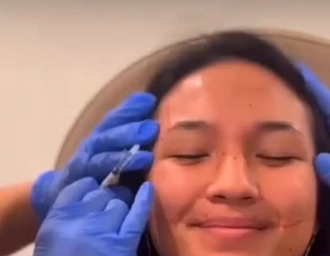 When should I start considering botox?