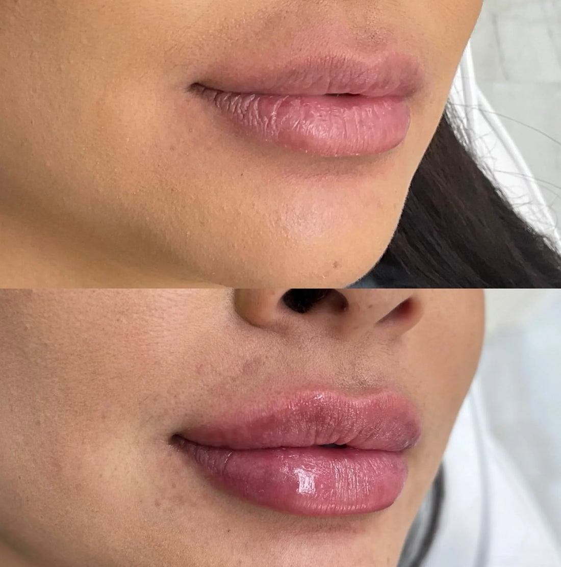 What is lip filler?