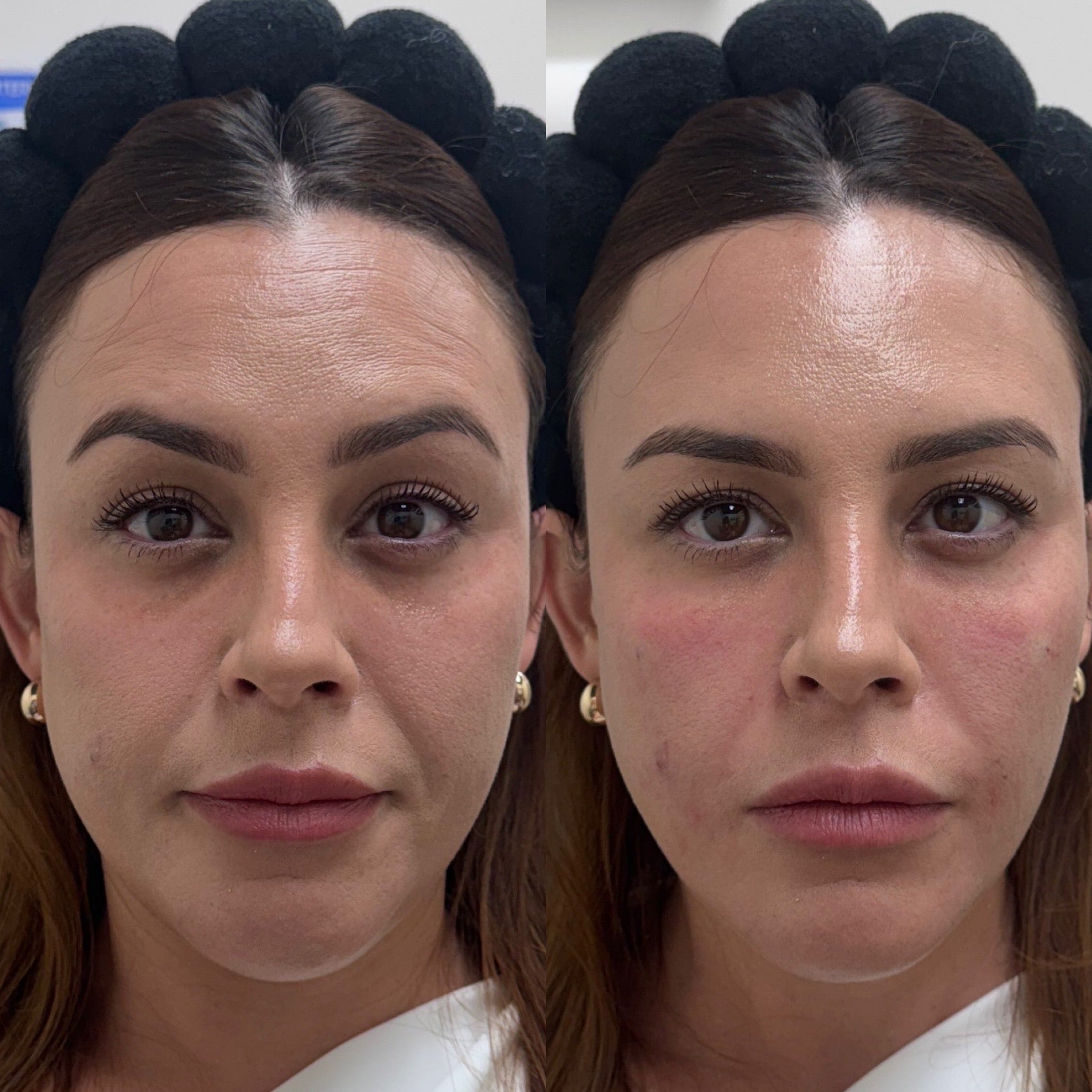 PRF Rejuvenation – FitLabHawaii